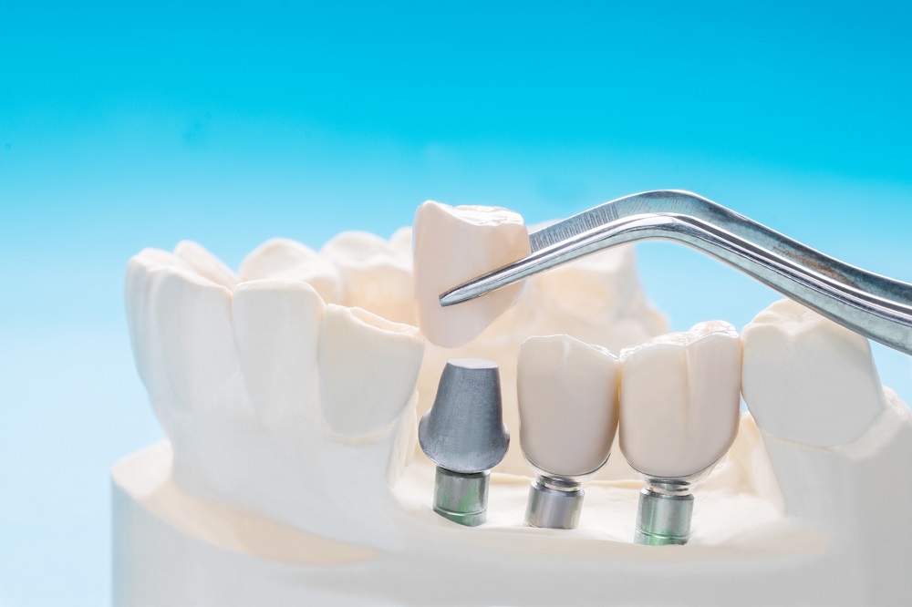 Założenie implantu zębowego a wiek pacjenta
