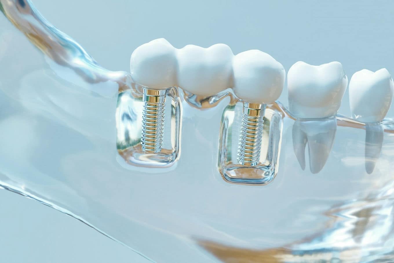 Dlaczego ważne jest, aby uzupełniać ubytki implantami?