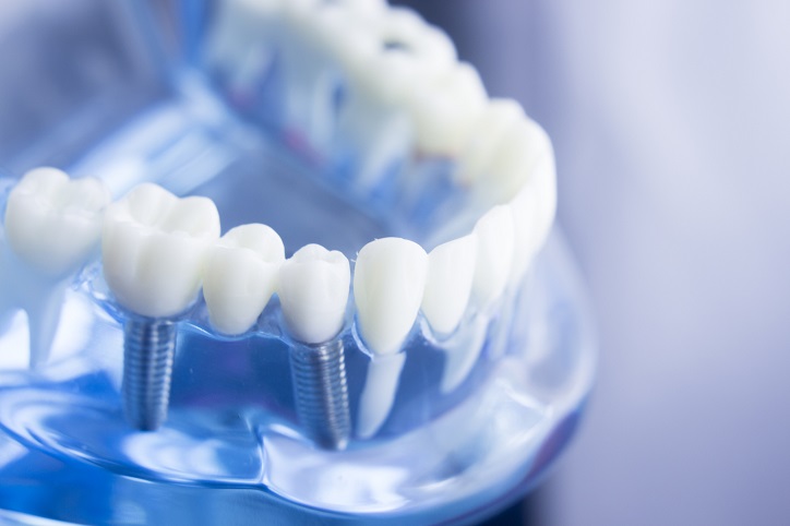 Czy warto się zdecydować na implanty zębowe?