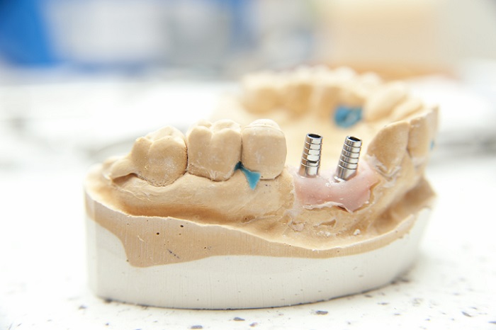 Jakie uzupełnienie zębowe wybrać - protezę czy implant?