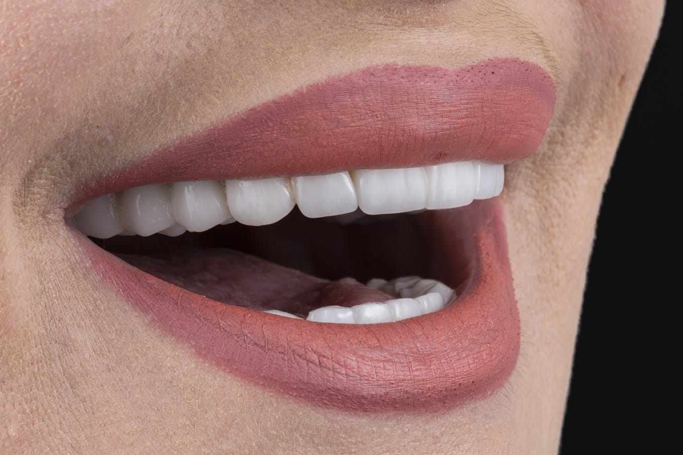 Rekomendacje dotyczące liczby licówek dla osób z szerokim uśmiechem