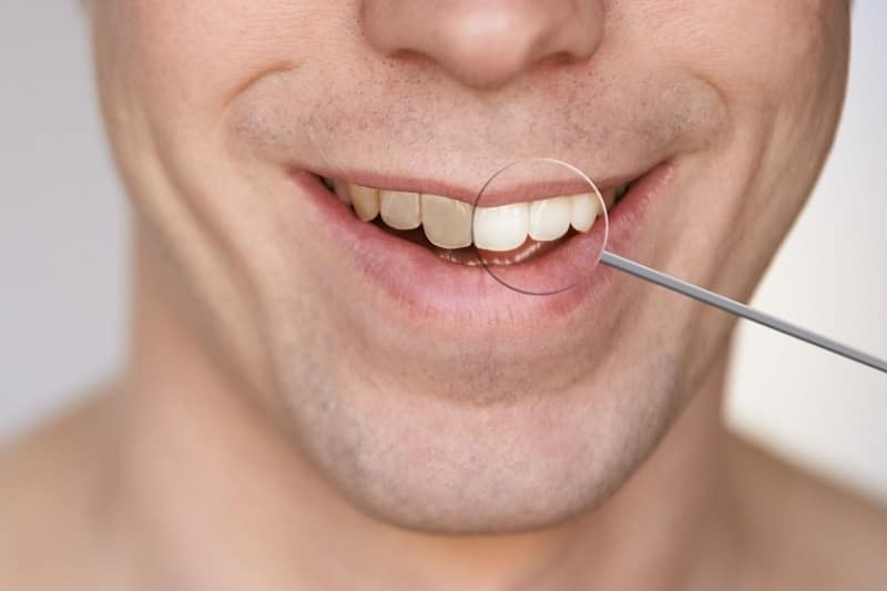 Co zrobić, by wybielanie zębów było bezpieczne?