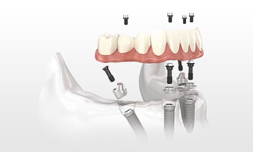 Dental Complex - implanty
